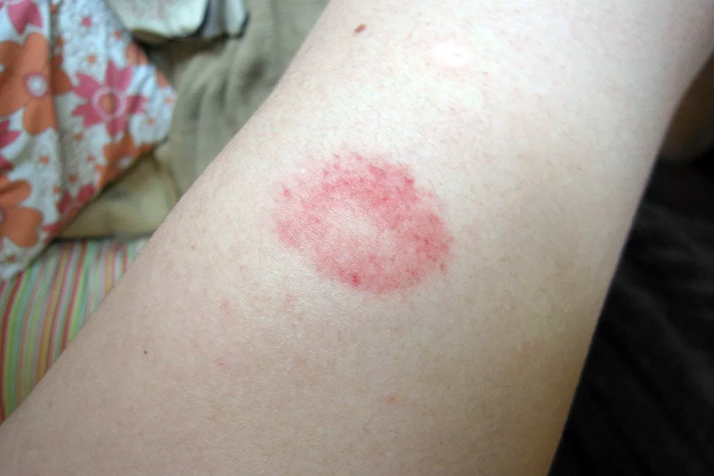The raised injuries in the image above are good examples of welts. The injury here is just a run-of-the-mill paintball bruise.